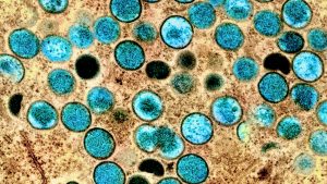 Colorized transmission electron micrograph of monkeypox particles (teal) found within an infected cell (brown).