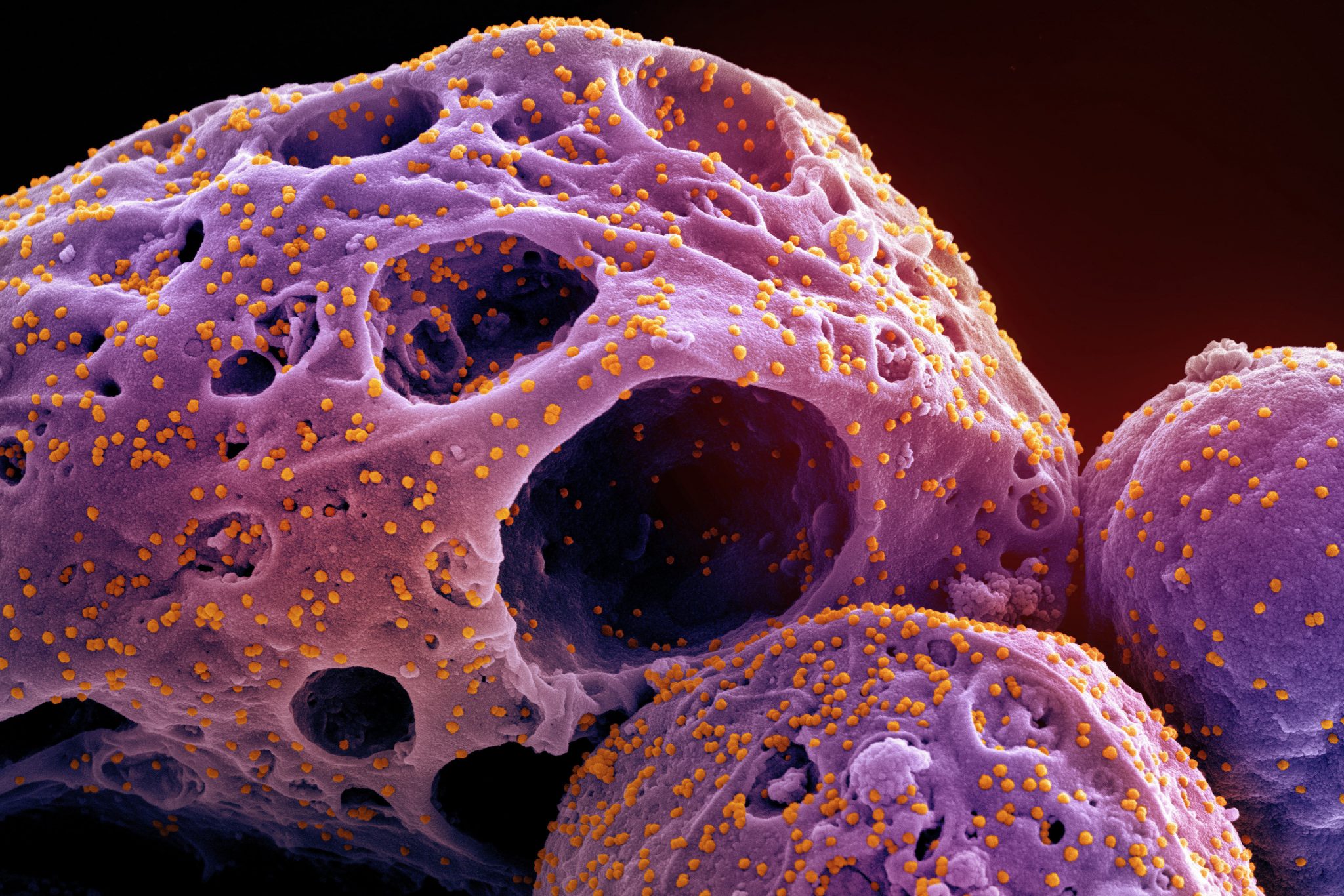 This colorized electron microscope image made available by the National Institute of Allergy and Infectious Diseases in November 2022, shows cells, indicated in purple, infected with the omicron strain of the SARS-CoV-2 virus, orange, isolated from a patient sample, captured at the NIAID Integrated Research Facility (IRF) in Fort Detrick, Md. (NIAID/NIH via AP)